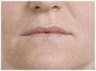 Botox and Dermal Fillers wrinkle removal at Kingswood Clinic in Blackburn 378608 Image 1